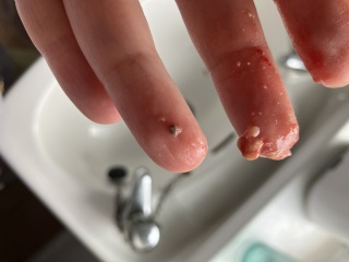 I think I have a cyst on top of my cyst (pics)