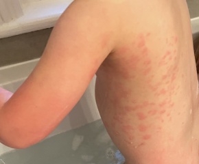 What is this rash please?