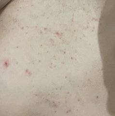Can anyone identify this rash.....
