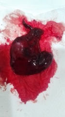 Blood clot or miscarriage? **MNHQ graphic pic warning**