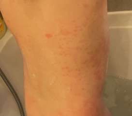 What is this rash please?