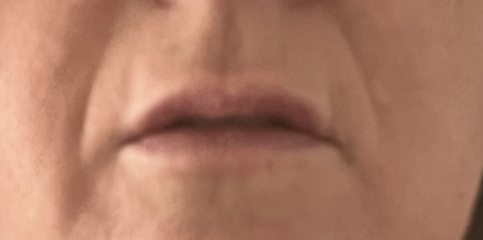 Lip Fillers - can I avoid this wrinkle?