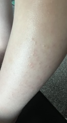 Eczema or intolerance?