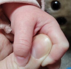 6 month old pimples/blisters??
