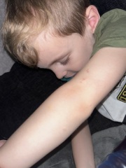 Chicken pox?