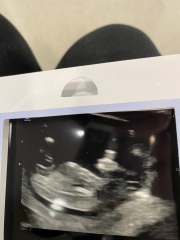 Baby ultrasound