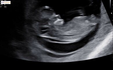 Worried about NT- 11week scan