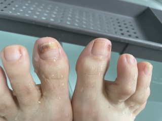 Toenails .. fungus... one toenail broken off