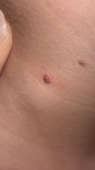 DS itched and aggravated mole