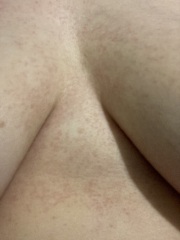 Between boobs sweat itch