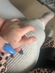 Hand foot & mouth or Chickenpox?