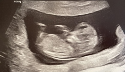 Boy or girl?