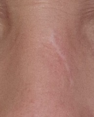 Well-meaning but ultimately misguided comments about my facial BCC