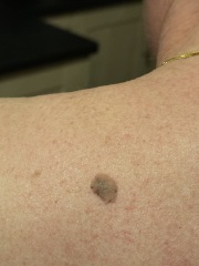 This mole - ? Melanoma? (Pics)
