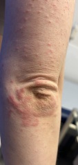 Itchy rash/red patches all over