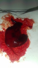 Blood clot or miscarriage? **MNHQ graphic pic warning**