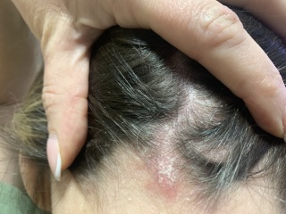 Skin issue. What is this ?