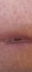 Appendix removal