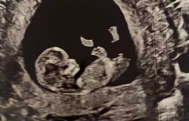 Nub theory / potty shot - boy or girl?