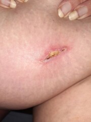 Appendix removal