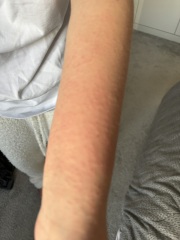 To take dd to out of hours with this rash?