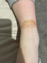 Strange 'rash' on 13 year old