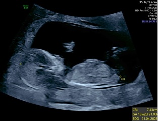 Boy or Girl? 12 week scan