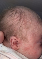 Baby acne or something else?