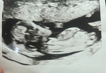 13 week scan, boy or girl?