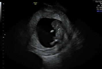 Any fun gender guesses? Early scan