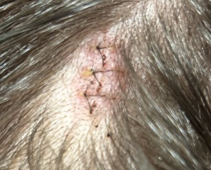 AIBU to think my stitches may be infected?