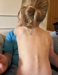 Toddlers spine shows a little