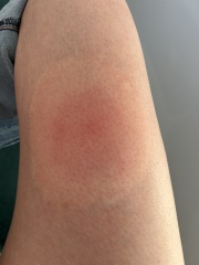 Lyme disease or ringworm?