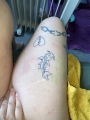 Horrible body rash!