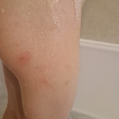 Chicken pox or bug bites