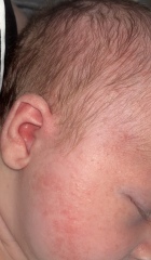 Baby acne or something else?