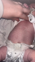 ? Allergy rash