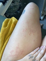 Horrible body rash!