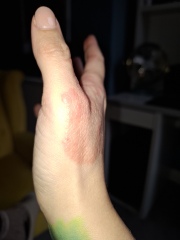 Hand infected (Warning, gross photos)