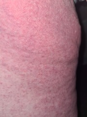Debilitating Thighs