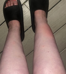 Is this bite concerning
