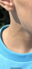 DS itched and aggravated mole