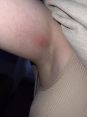 Lump in armpit - need advice!