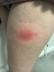 Lyme disease or ringworm?