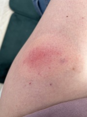 Lyme disease or ringworm?