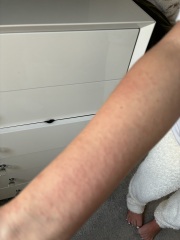 To take dd to out of hours with this rash?