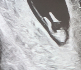 Nub theory / potty shot - boy or girl?
