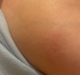 Hand holding - worried about a small rash (picture)
