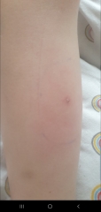 Chicken pox or bug bites