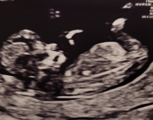 Any guesses girl or boy? 💗💙